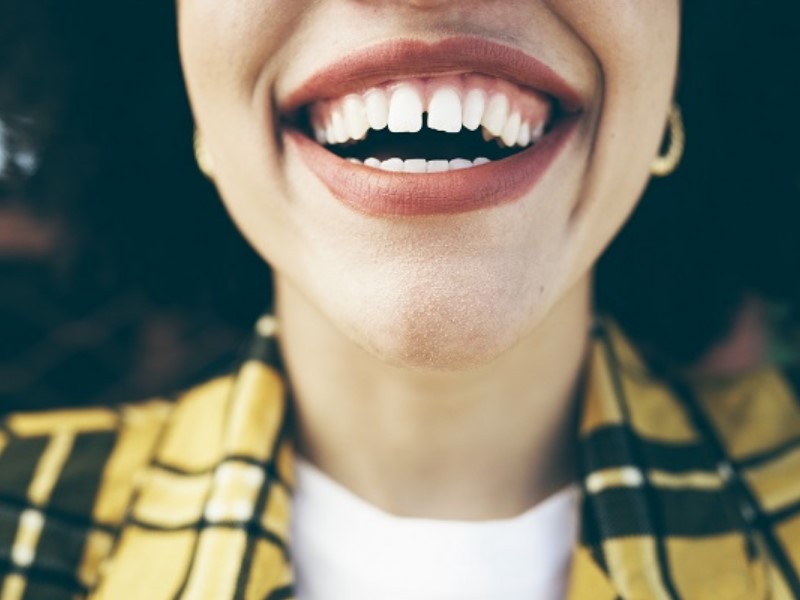 Pri paradontalni bolezni med zobmi nastajajo špranje in zobje lezejo narazen. 